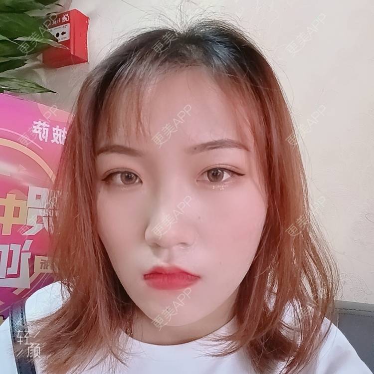 更美 - 更美用户tbs28rKiLZ的定点双眼皮经验 | 定点双眼皮 | 杭州