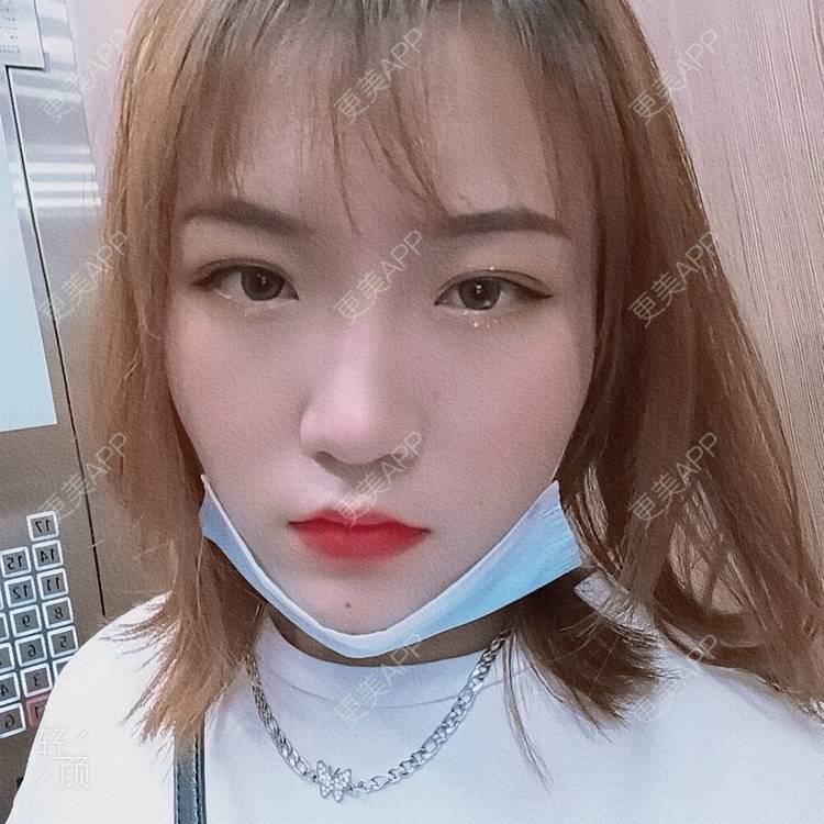 更美 - 更美用户tbs28rKiLZ的定点双眼皮经验 | 定点双眼皮 | 杭州