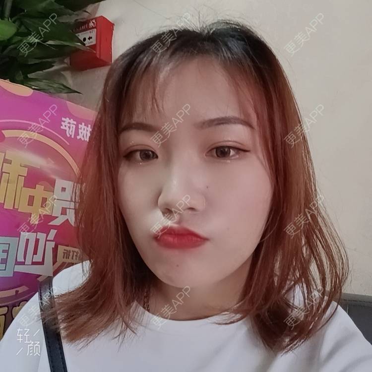 更美 - 更美用户tbs28rKiLZ的定点双眼皮经验 | 定点双眼皮 | 杭州