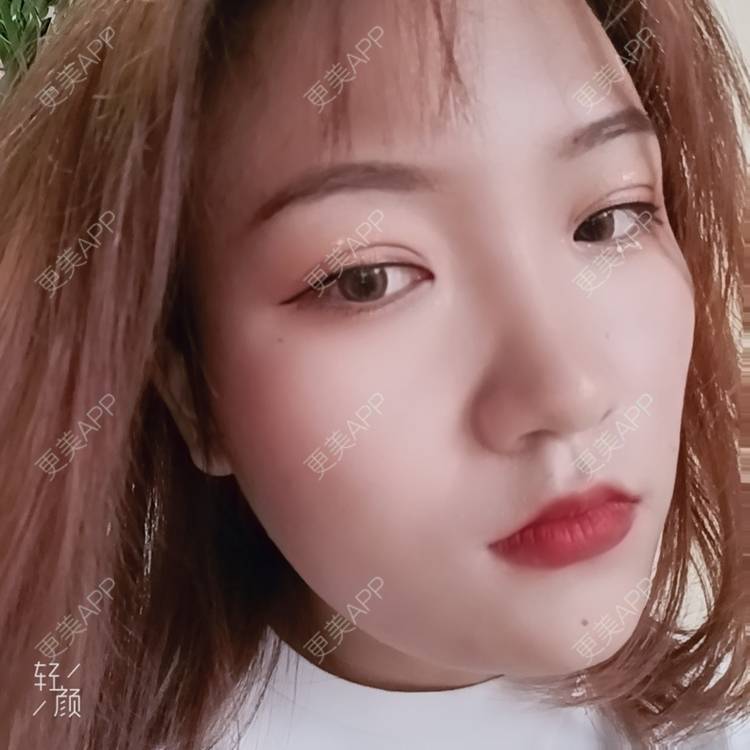 更美 - 更美用户tbs28rKiLZ的定点双眼皮经验 | 定点双眼皮 | 杭州