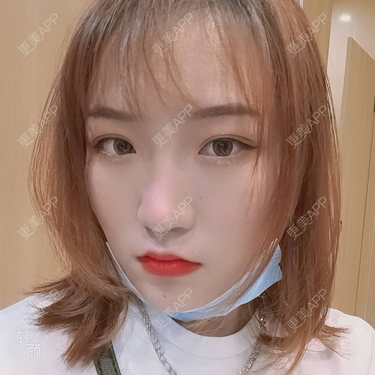 更美 - 更美用户tbs28rKiLZ的定点双眼皮经验 | 定点双眼皮 | 杭州