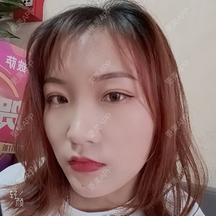 更美 - 更美用户tbs28rKiLZ的定点双眼皮经验 | 定点双眼皮 | 杭州