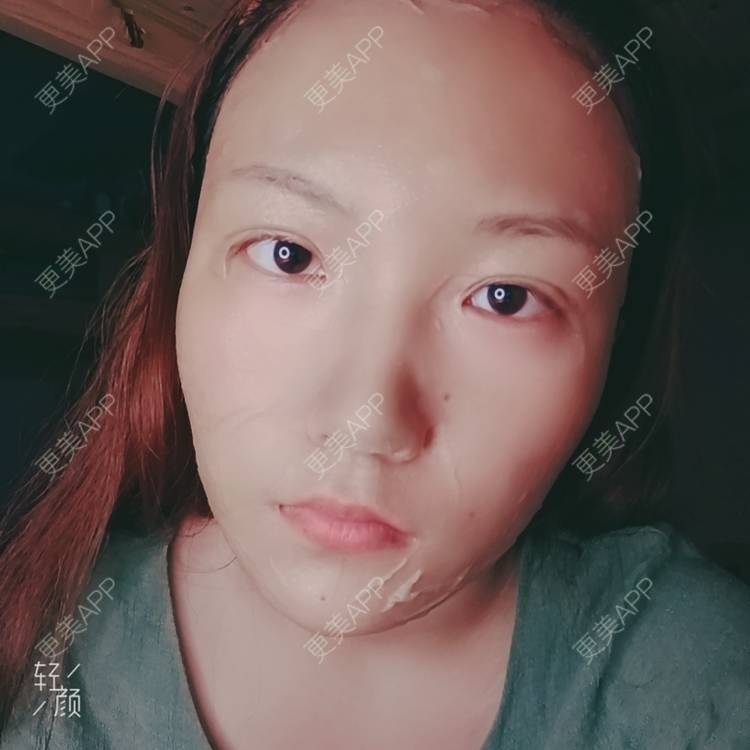 更美 - 更美用户tbs28rKiLZ的定点双眼皮经验 | 定点双眼皮 | 杭州