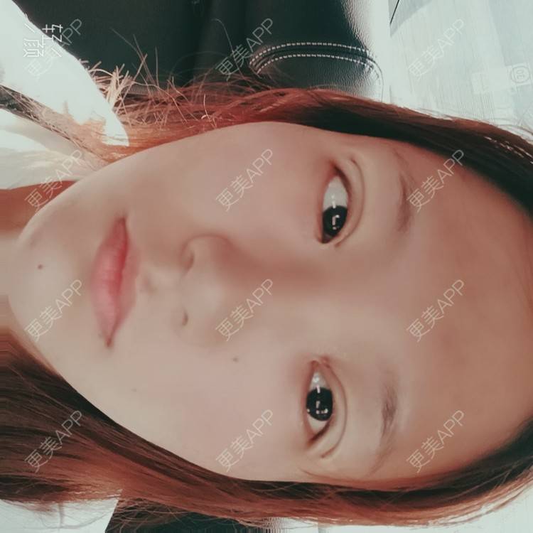 更美 - 更美用户tbs28rKiLZ的定点双眼皮经验 | 定点双眼皮 | 杭州