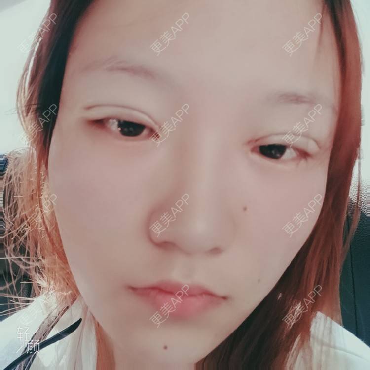 更美 - 更美用户tbs28rKiLZ的定点双眼皮经验 | 定点双眼皮 | 杭州