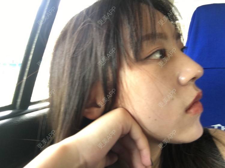 更美 - 吃飯從來用湯勺√的自体脂肪隆鼻经验 | 成都 | 自体脂肪隆鼻 | 视频日记