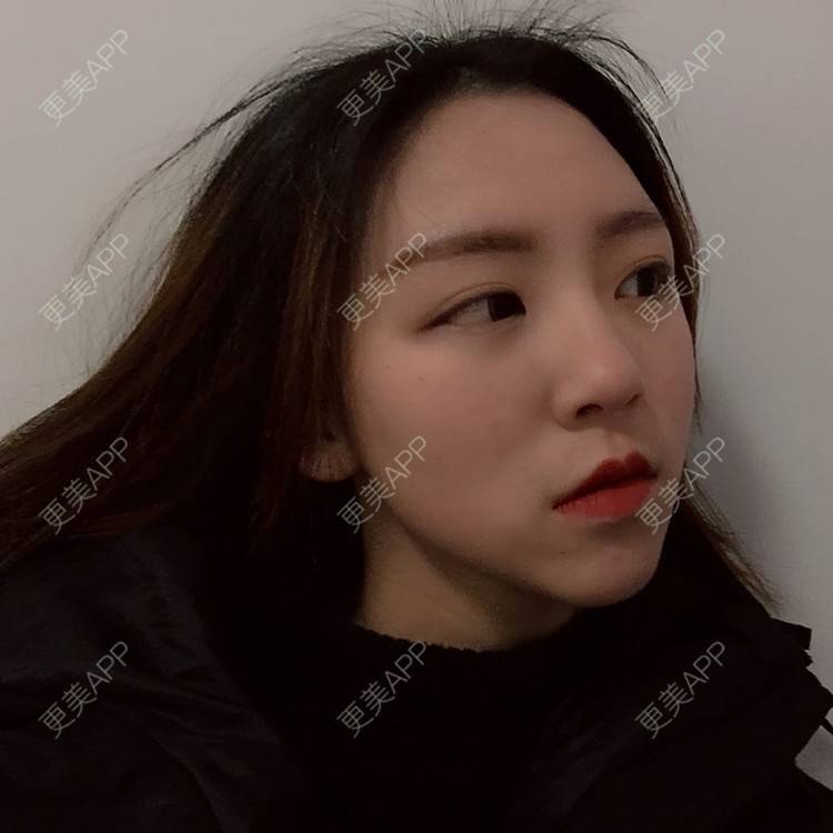 更美 - 吃飯從來用湯勺√的自体脂肪隆鼻经验 | 成都 | 自体脂肪隆鼻 | 视频日记