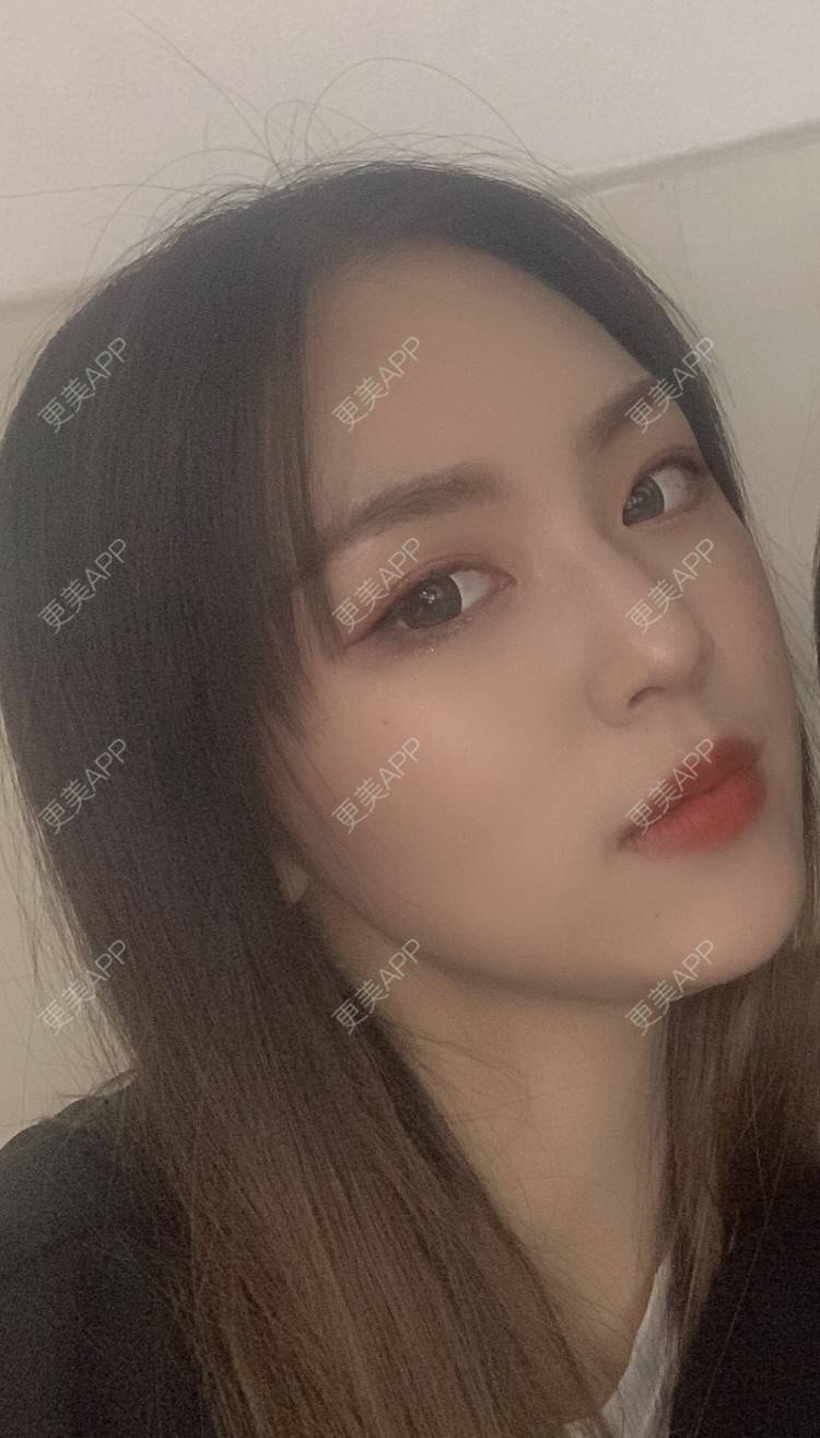 更美 - 吃飯從來用湯勺√的自体脂肪隆鼻经验 | 成都 | 自体脂肪隆鼻 | 视频日记