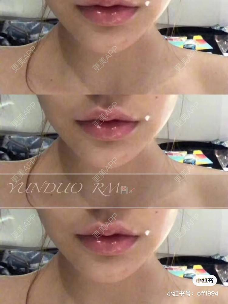 更美 - 更美用户GD1uNHqtV2的除皱瘦脸经验 | 除皱瘦脸 | 杭州