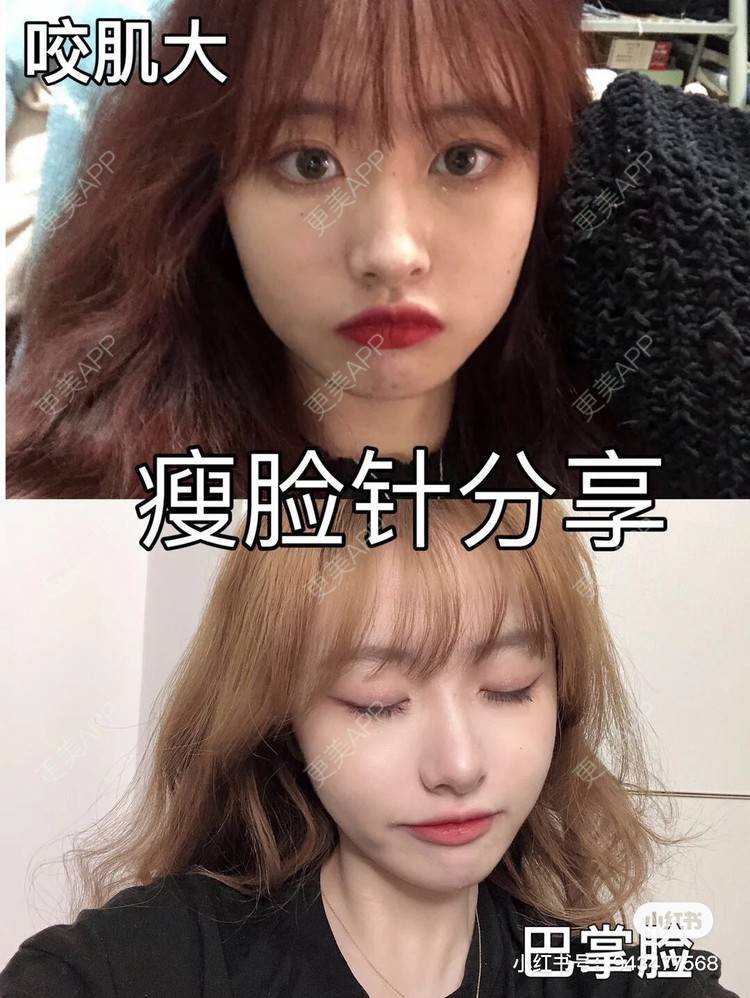 更美 - 更美用户GD1uNHqtV2的除皱瘦脸经验 | 除皱瘦脸 | 杭州
