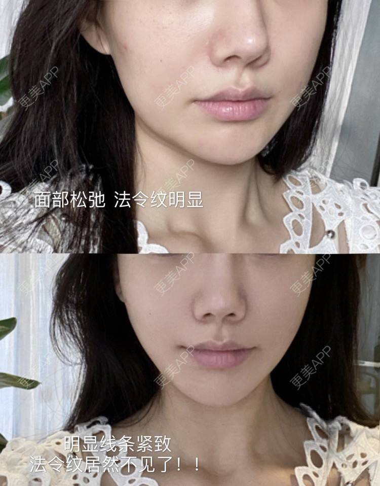 更美 - 真人小助手的热玛吉经验 | 重庆 | 热玛吉