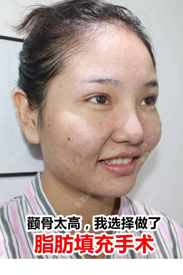 更美 - 陈玉琼 医生的自体脂肪丰面颊经验 | 自体脂肪全面部填充 | 自体脂肪丰面颊 | 自体脂肪丰太阳穴 | 昆明