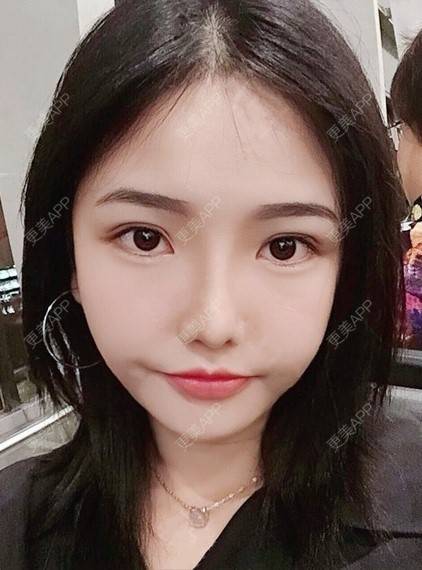 更美 - 陈玉琼 医生的自体脂肪丰面颊经验 | 自体脂肪全面部填充 | 自体脂肪丰面颊 | 自体脂肪丰太阳穴 | 昆明