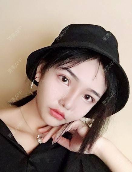 更美 - 陈玉琼 医生的自体脂肪丰面颊经验 | 自体脂肪全面部填充 | 自体脂肪丰面颊 | 自体脂肪丰太阳穴 | 昆明
