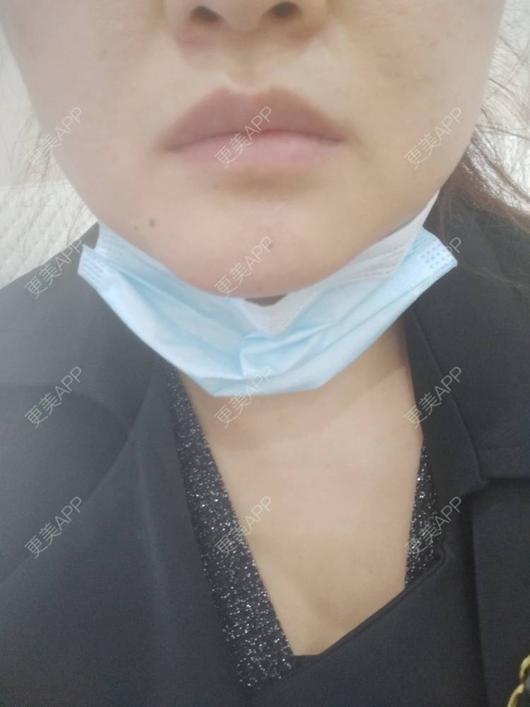 更美 - 更美用户7984508725的除皱瘦脸经验 | 除皱瘦脸 | 南京