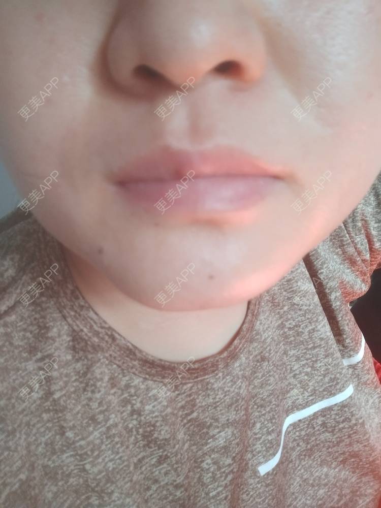 更美 - 更美用户7984508725的除皱瘦脸经验 | 除皱瘦脸 | 南京