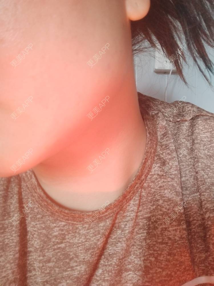 更美 - 更美用户7984508725的除皱瘦脸经验 | 除皱瘦脸 | 南京