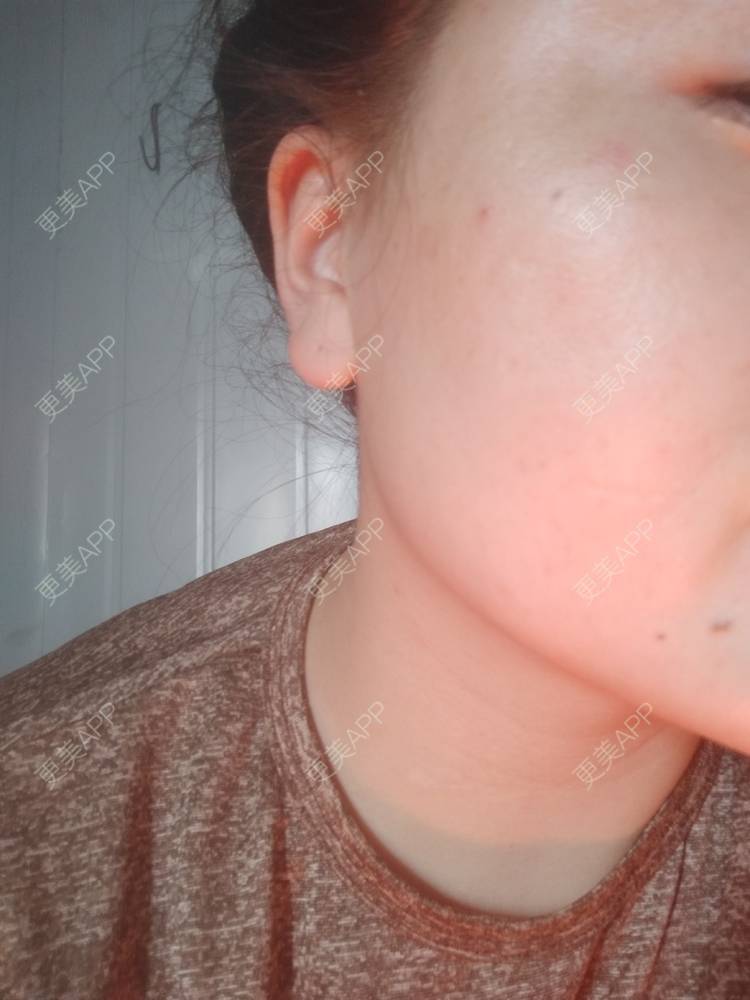 更美 - 更美用户7984508725的除皱瘦脸经验 | 除皱瘦脸 | 南京