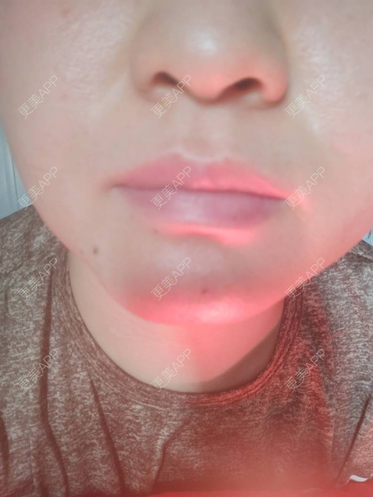 更美 - 更美用户7984508725的除皱瘦脸经验 | 除皱瘦脸 | 南京