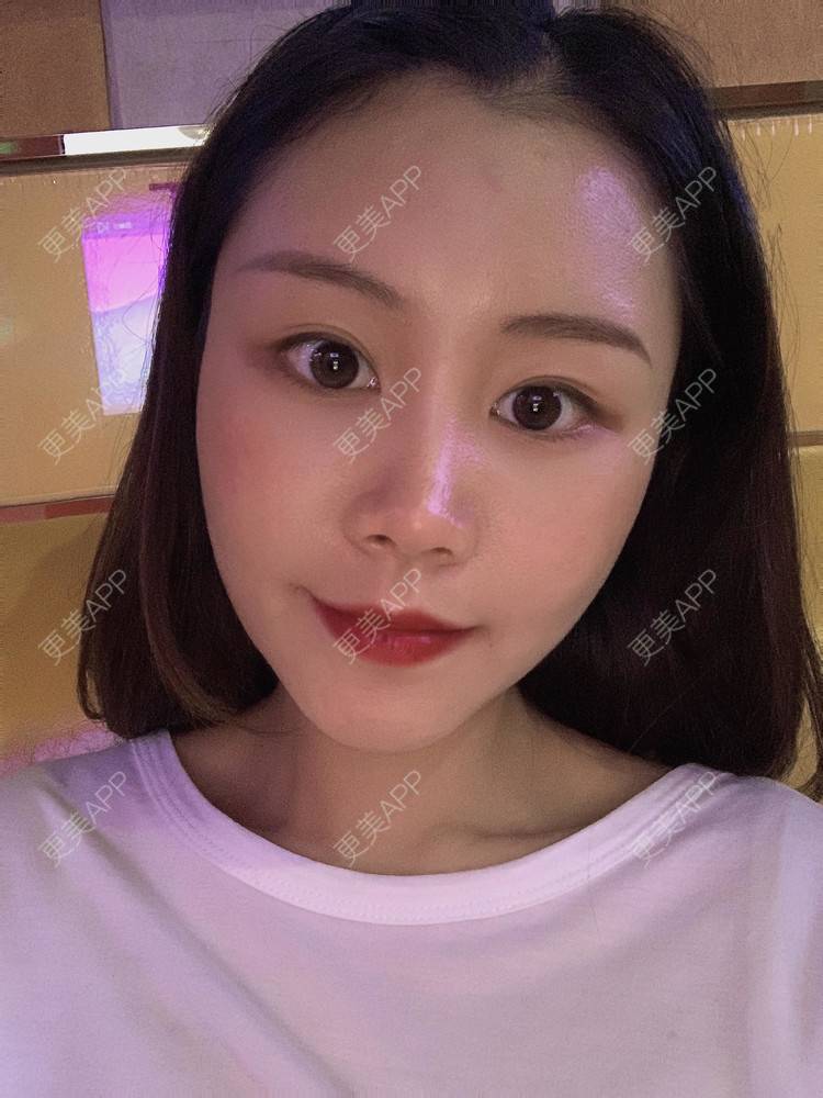 更美 - 喵咩咩胀的胶原蛋白丰面颊经验 | 自体脂肪面部填充 | 北京 | 胶原蛋白丰面颊