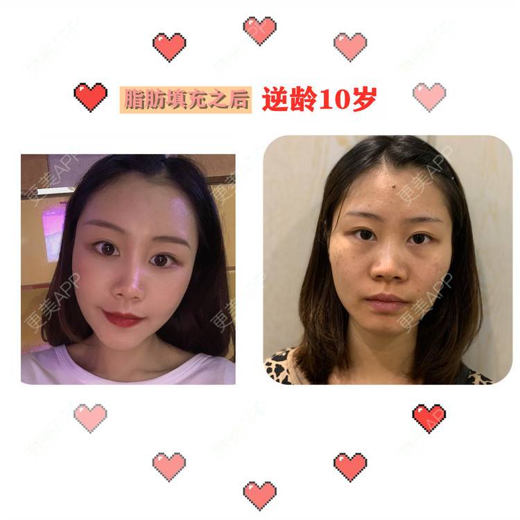 更美 - 喵咩咩胀的胶原蛋白丰面颊经验 | 自体脂肪面部填充 | 北京 | 胶原蛋白丰面颊