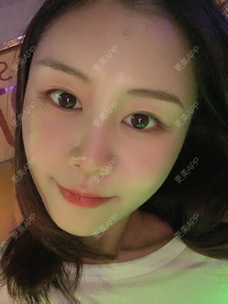 更美 - 喵咩咩胀的胶原蛋白丰面颊经验 | 自体脂肪面部填充 | 北京 | 胶原蛋白丰面颊