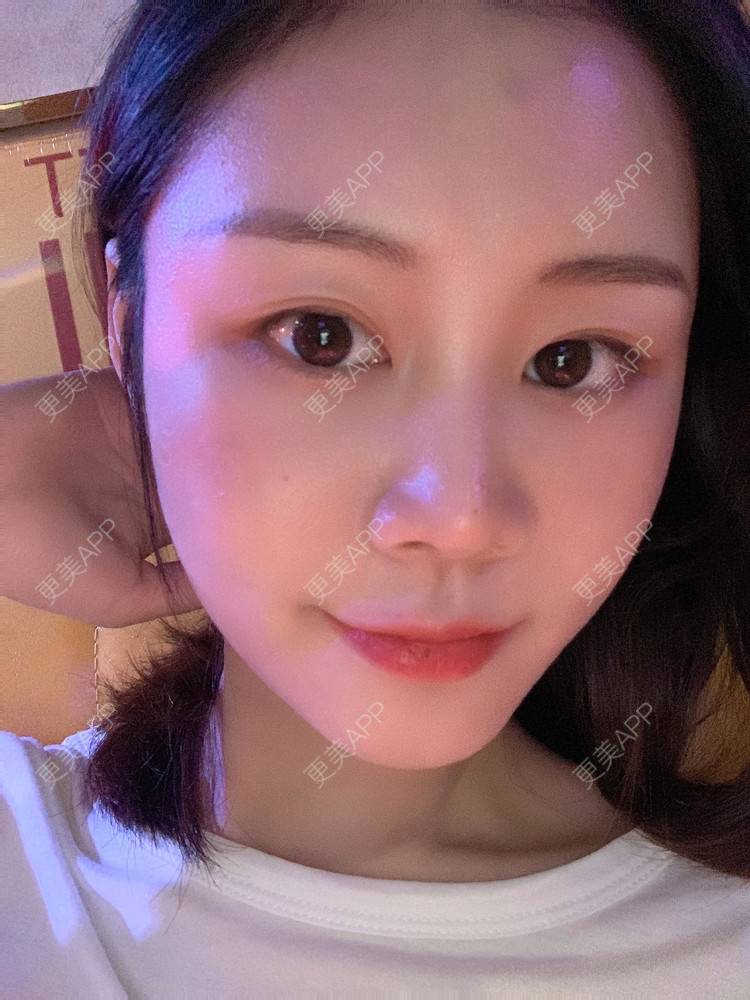 更美 - 喵咩咩胀的胶原蛋白丰面颊经验 | 自体脂肪面部填充 | 北京 | 胶原蛋白丰面颊