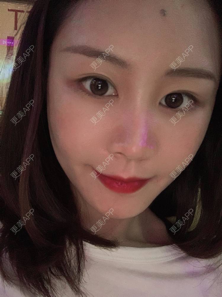 更美 - 喵咩咩胀的胶原蛋白丰面颊经验 | 自体脂肪面部填充 | 北京 | 胶原蛋白丰面颊