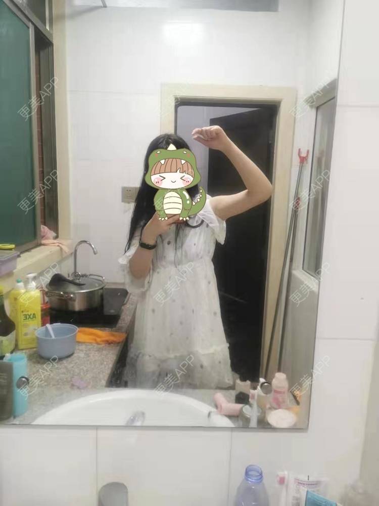 更美 - 更美用户jHjijlJNxV的手臂吸脂经验 | 手臂吸脂 | 广州