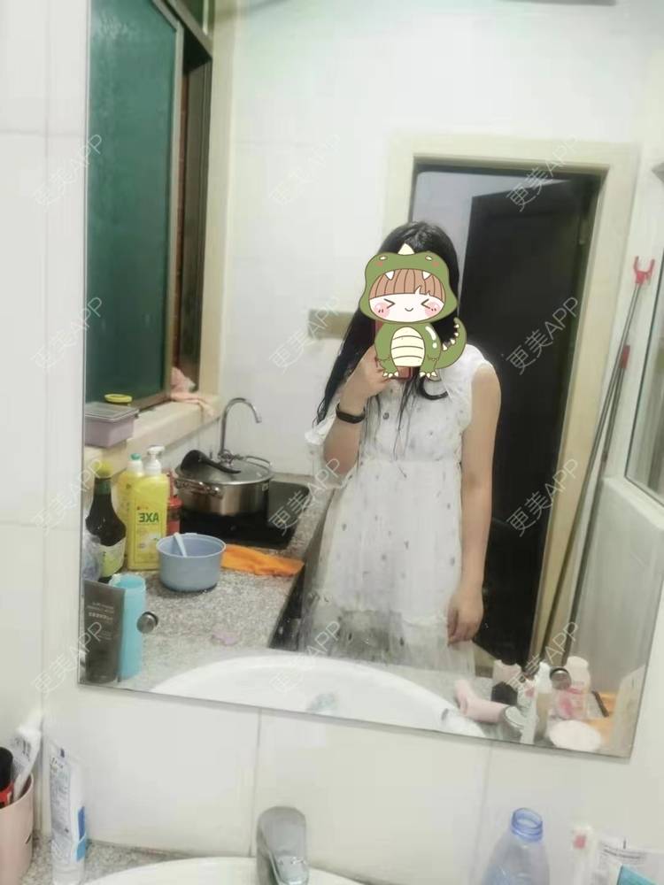 更美 - 更美用户jHjijlJNxV的手臂吸脂经验 | 手臂吸脂 | 广州