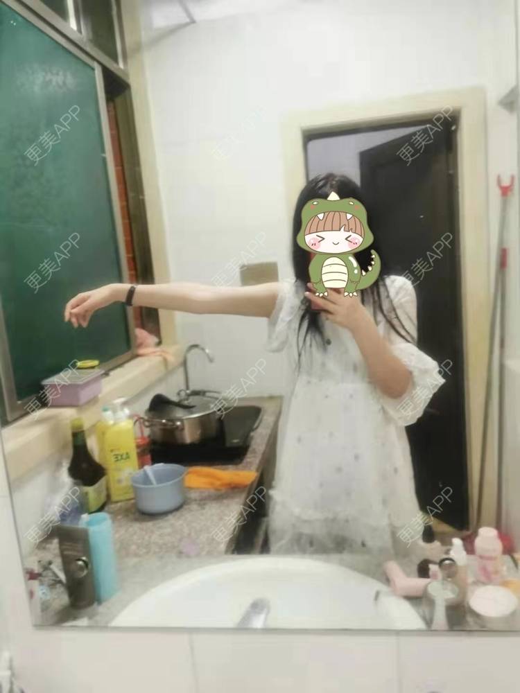 更美 - 更美用户jHjijlJNxV的手臂吸脂经验 | 手臂吸脂 | 广州
