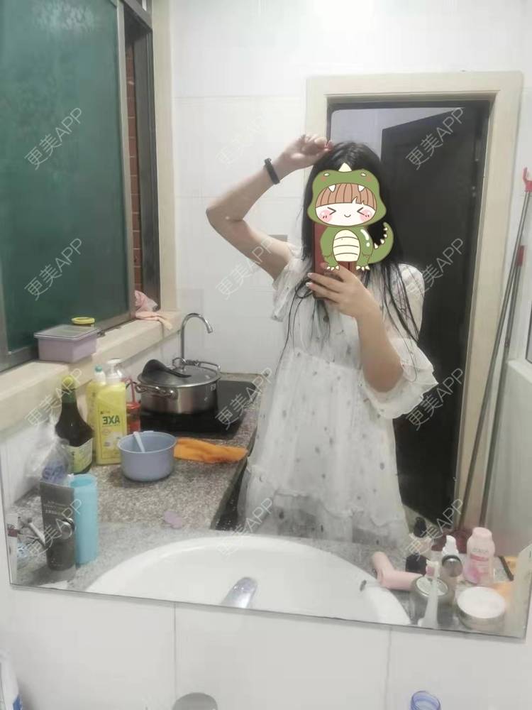 更美 - 更美用户jHjijlJNxV的手臂吸脂经验 | 手臂吸脂 | 广州