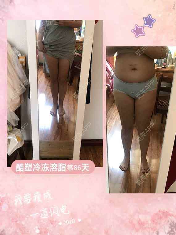更美 - 更美用户8jDUMjrMkn的冷冻减脂瘦大腿经验 | 冷冻溶脂 | 冷冻减脂瘦大腿