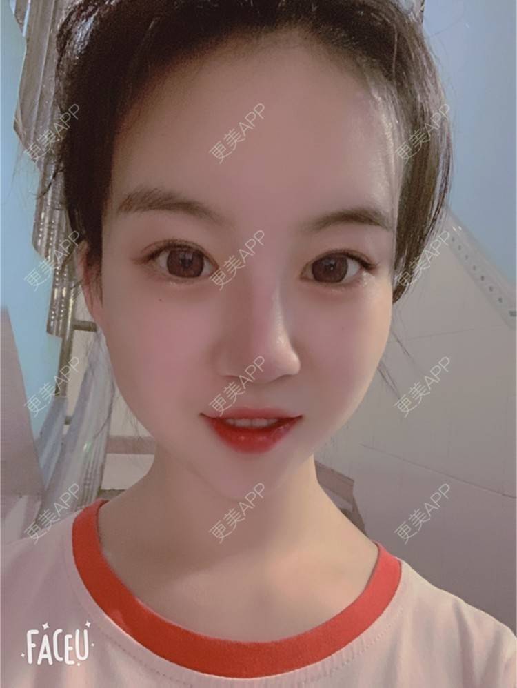 更美 - 甜宠女主的除皱瘦脸经验 | 除皱瘦脸 | 深圳