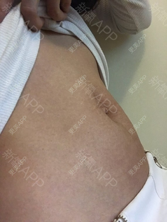 更美 - 更美用户uE6d85E3O0的妊娠纹经验 | 厦门 | 妊娠纹