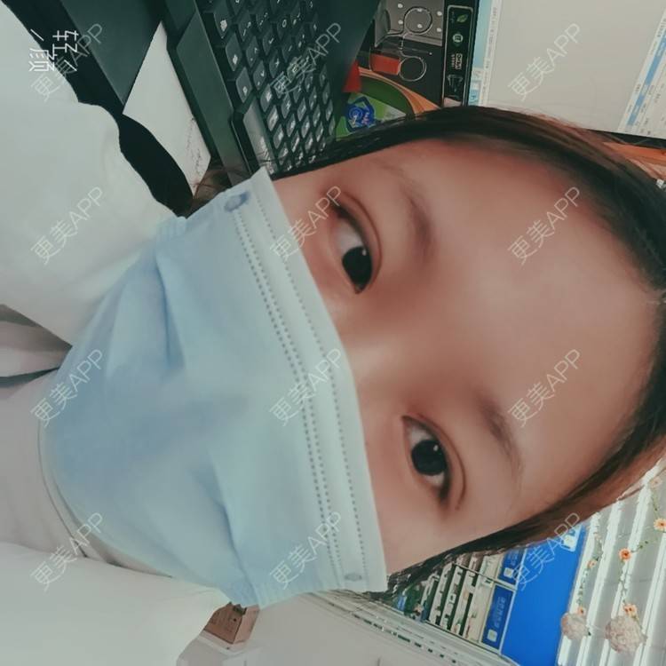 更美 - 更美用户tbs28rKiLZ的定点双眼皮经验 | 定点双眼皮 | 杭州