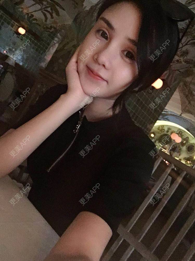更美 - 可可柠檬的自体脂肪丰苹果肌经验 | 重庆 | 自体脂肪丰太阳穴 | 自体脂肪丰面颊 | 自体脂肪丰额头 | 自体脂肪丰苹果肌 | 自体脂肪垫下巴