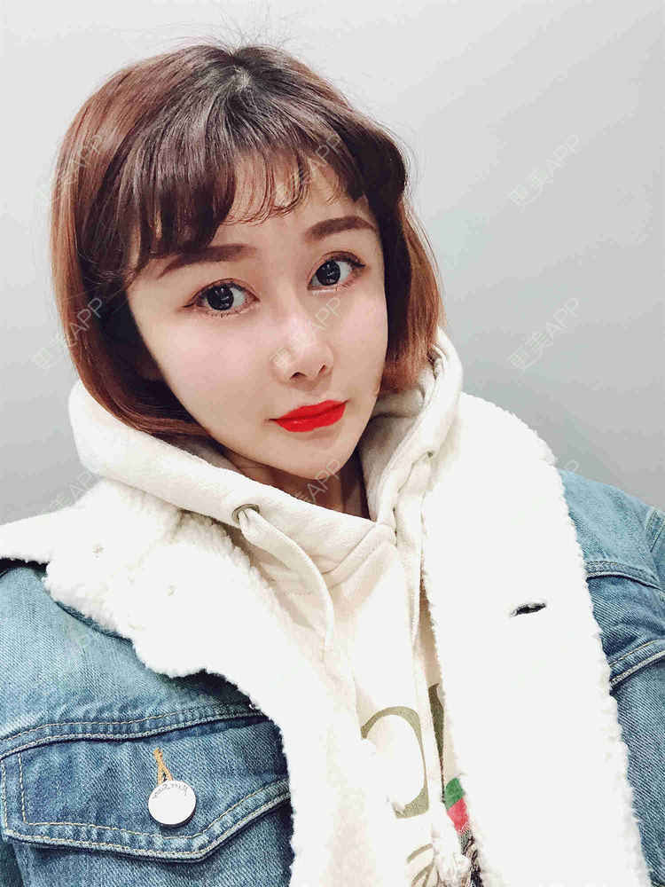 更美 - 月妹儿1027的自体脂肪丰苹果肌经验 | 自体脂肪全面部填充 | 视频日记 | 自体脂肪丰面颊 | 自体脂肪丰太阳穴 | 埋线提升 | 重庆 | 自体脂肪丰额头 | 自体脂肪丰苹果肌