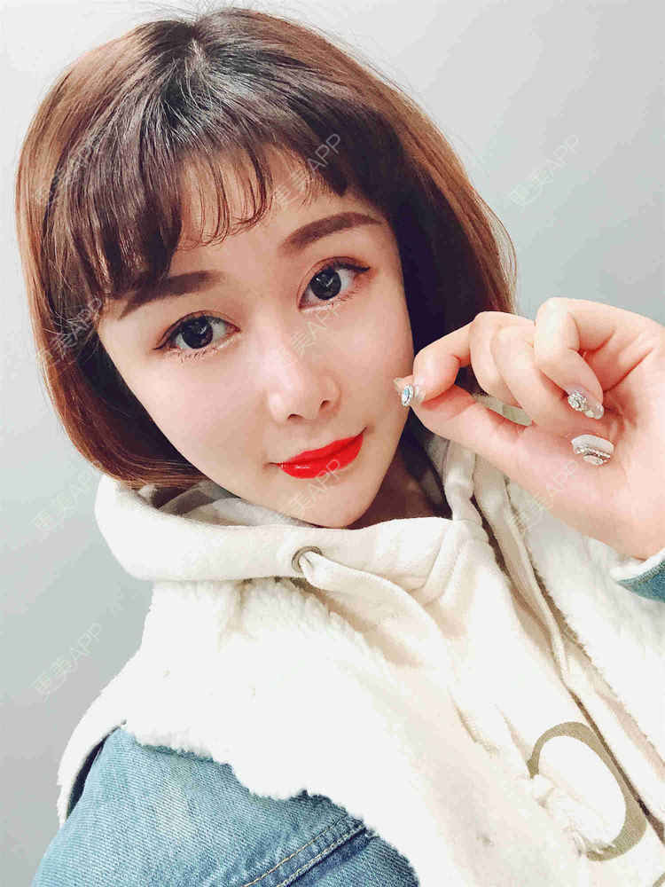 更美 - 月妹儿1027的自体脂肪丰苹果肌经验 | 自体脂肪全面部填充 | 视频日记 | 自体脂肪丰面颊 | 自体脂肪丰太阳穴 | 埋线提升 | 重庆 | 自体脂肪丰额头 | 自体脂肪丰苹果肌