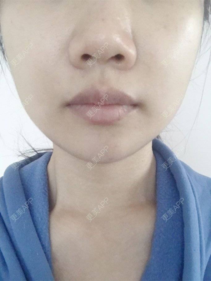 更美 - 小胖兔的玻尿酸鼻部经验 | 玻尿酸鼻部 | 天津 | 玻尿酸鼻基底