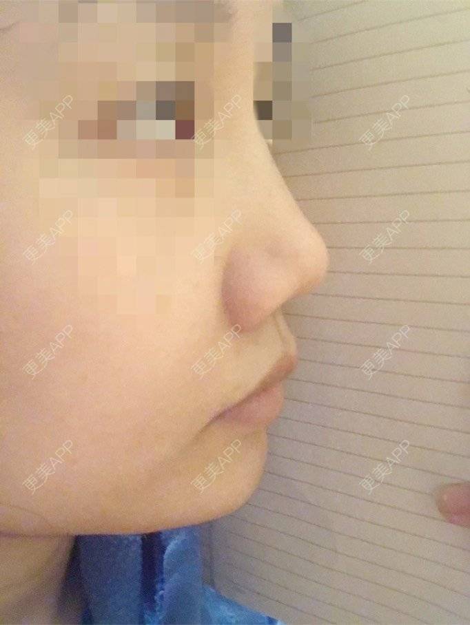 更美 - 小胖兔的玻尿酸鼻部经验 | 玻尿酸鼻部 | 天津 | 玻尿酸鼻基底
