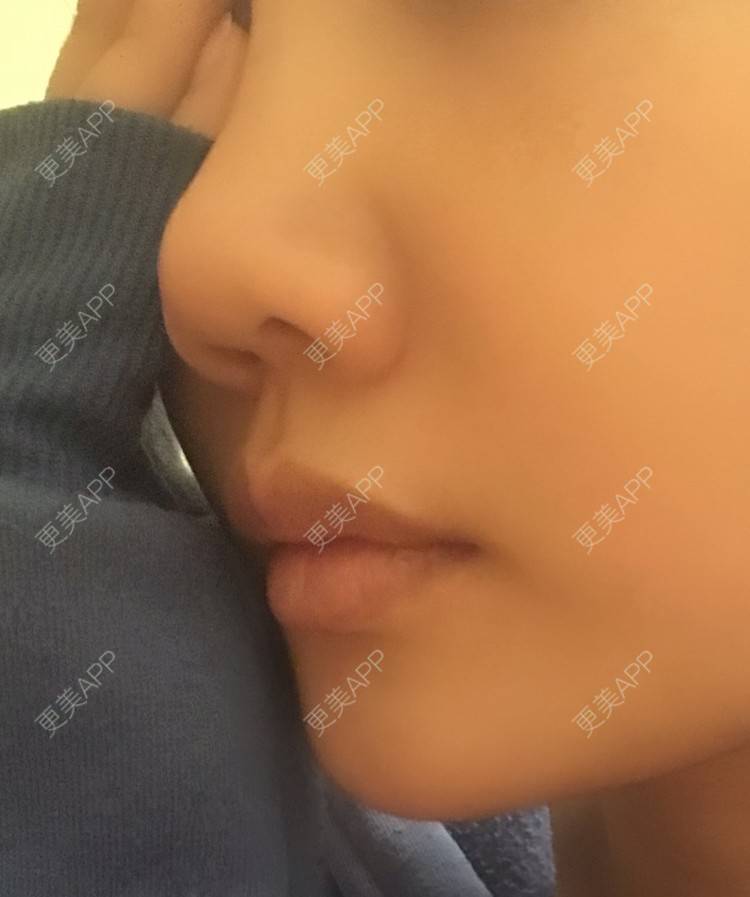 更美 - 小胖兔的玻尿酸鼻部经验 | 玻尿酸鼻部 | 天津 | 玻尿酸鼻基底