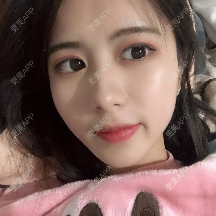 更美 - 更美用户e3UQ3Qy244的隆鼻经验 | 视频日记 | 佛山 | 隆鼻