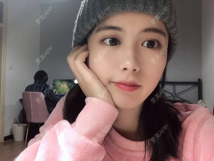 更美 - 更美用户e3UQ3Qy244的隆鼻经验 | 视频日记 | 佛山 | 隆鼻