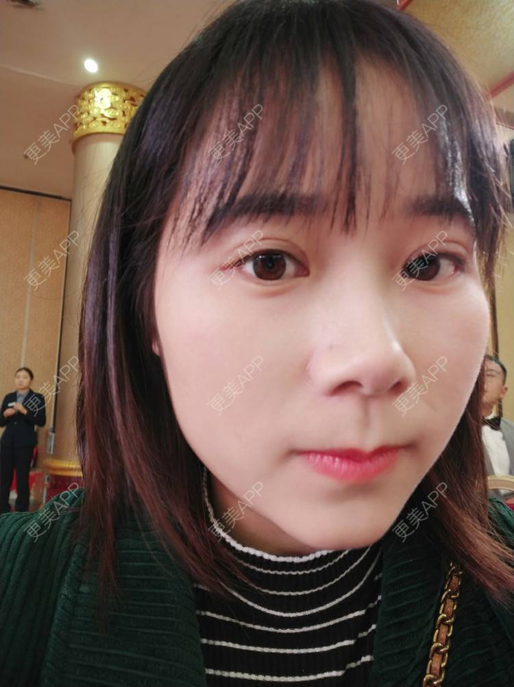 更美 - 更美用户2xnQj47lDg的眼部综合经验 | 眼部综合 | 重庆