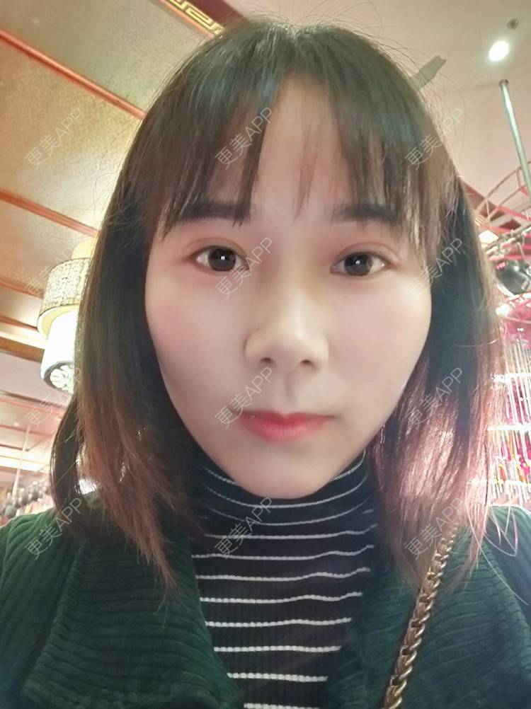 更美 - 更美用户2xnQj47lDg的眼部综合经验 | 眼部综合 | 重庆