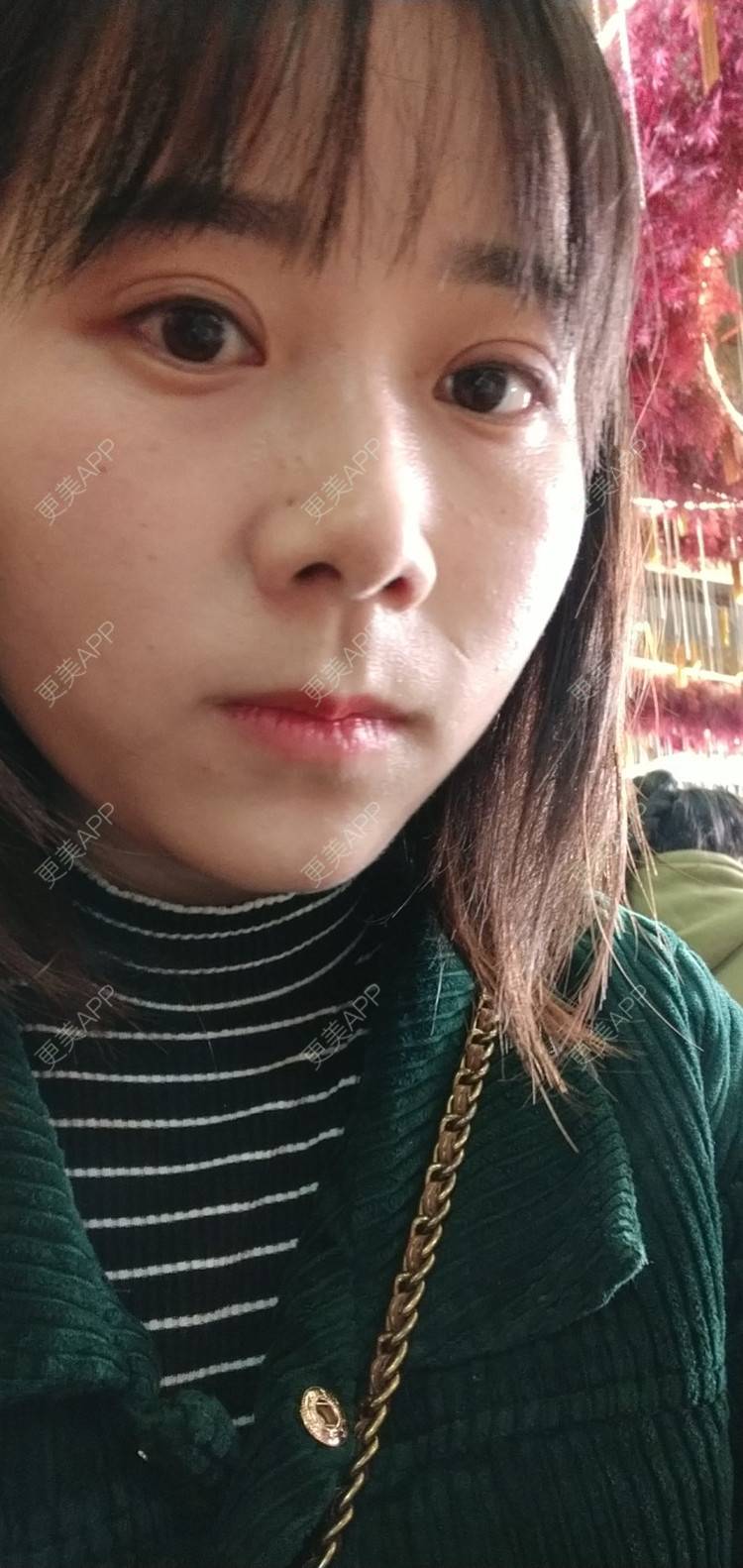 更美 - 更美用户2xnQj47lDg的眼部综合经验 | 眼部综合 | 重庆