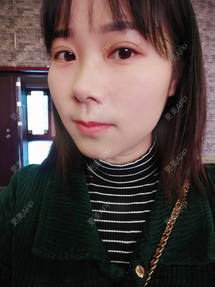 更美 - 更美用户2xnQj47lDg的眼部综合经验 | 眼部综合 | 重庆