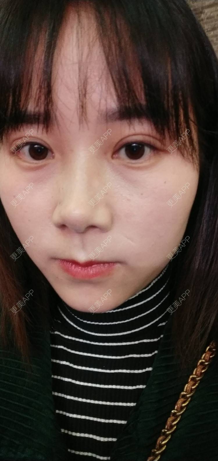 更美 - 更美用户2xnQj47lDg的眼部综合经验 | 眼部综合 | 重庆