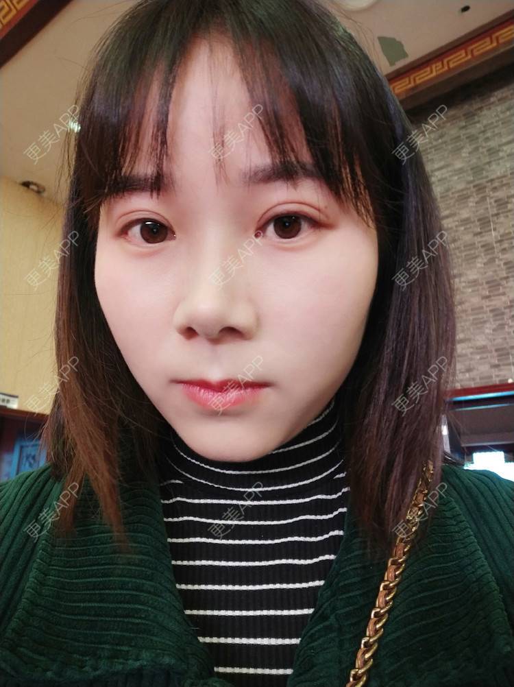 更美 - 更美用户2xnQj47lDg的眼部综合经验 | 眼部综合 | 重庆